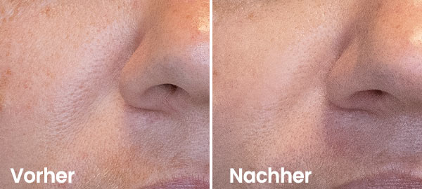Warum ein Aqua Facial?